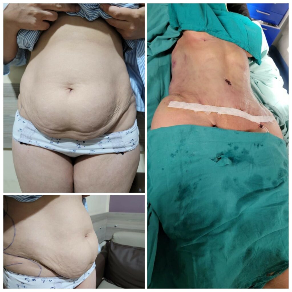 شفط دهون للبطن مع إبراز السي كيرف